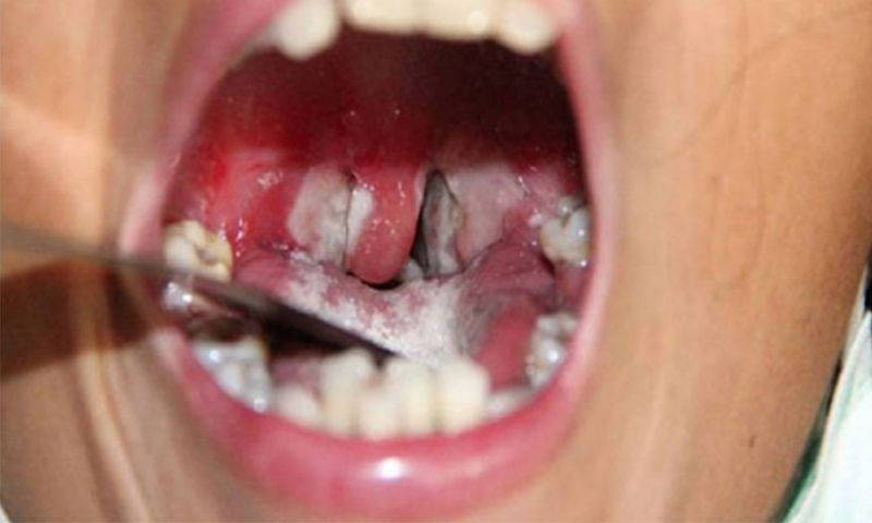 Tăng cường xét nghiệm, chẩn đoán bệnh bạch hầu