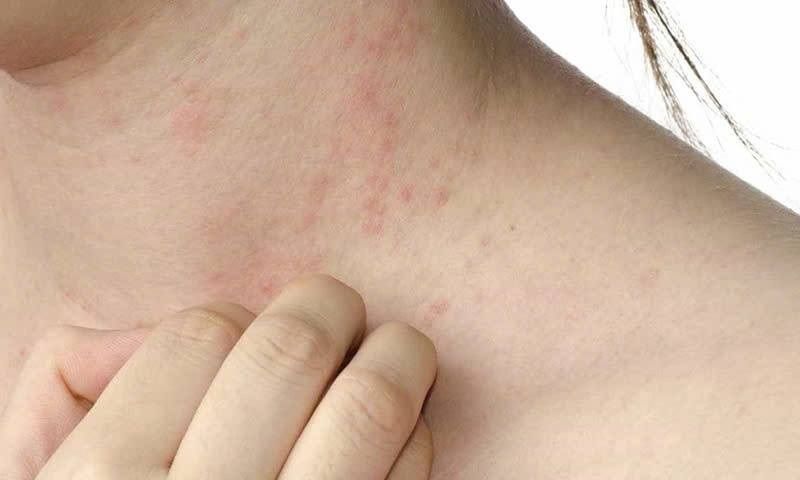 Hơn 8.600 ca mắc sởi, 10 trường hợp tử vong